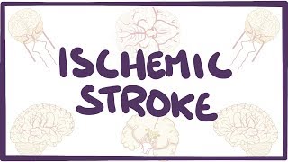 Ischemic Stroke  causes symptoms diagnosis treatment pathology [upl. by Harmony]