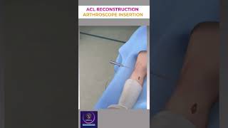 ACL Reconstruction Arthroscope Insertion Procedure shorts [upl. by Eded]