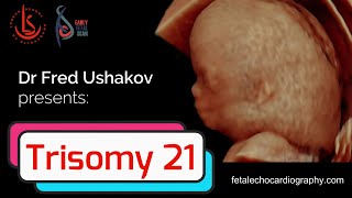 Trisomy 21 Challenges in screening diagnosis and management of Downs syndrome [upl. by Suivat]