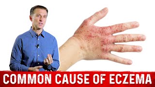 Is Your Eczema Coming from a Salicylate Sensitivity – Dr Berg On Atopic Dermatitis [upl. by Akcirehs]