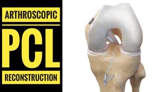 Arthroscopic PCL Posterior Cruciate LigamentReconstruction with Hamstring Graft [upl. by Ahsiken]