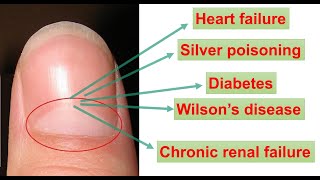 BIOLOGY BEHIND HALFMOON SHAPE ON OUR FINGERNAILS WHITEBLACKYELLOW SPOT ON NAIL LUNULAE [upl. by Mauldon931]