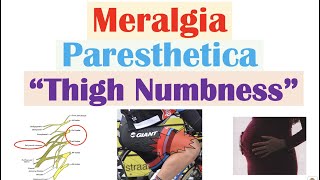 Meralgia Paresthetica “Numbness of the Thigh”  Causes Symptoms Diagnosis Treatment [upl. by Ardnaek]