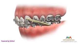 Orthodontic Treatment for Overjet Overbite  Rubber Bands [upl. by Anihpled]