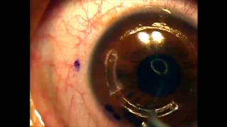 Intacs for keratoconus using the intralase femtosecond laser [upl. by Gayl666]