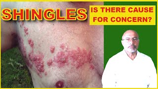 Shingles Symptoms Treatment Complications [upl. by Inoek]