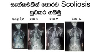 How to correct scoliosis without surgery [upl. by Etterrag815]