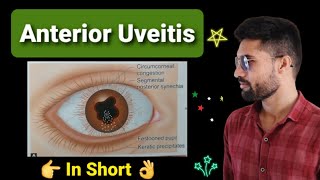 Anterior uveitis lecture opthalmology [upl. by Julie907]