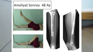 Tibia Proksimal Ewing Sarkom Diz [upl. by Orella]