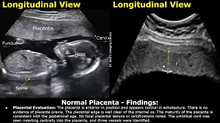 Placenta Ultrasound Reporting  How To Write Pregnancy USG Reports  Pathologies amp Positions Scans [upl. by Audie]