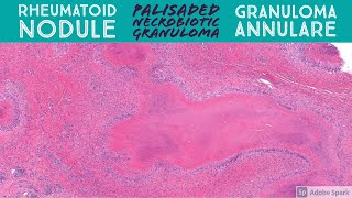 Rheumatoid Nodule amp Granuloma Annulare Palisaded Necrobiotic Granuloma Pattern Dermatopathology [upl. by Cranston]