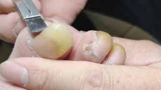 Oh long curved man patient keep 180days no1 toenail manicure [upl. by Yert226]