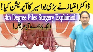 Operation of 4th Degree Piles  Haemorrhoidectomy of very big Piles  Surgeon Dr Imtiaz Hussain [upl. by Meekar]