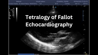 Tetralogy of Fallot  Point of Care ECHO  Short Video [upl. by Barthelemy680]