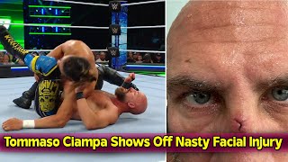 Tommaso Ciampa Shows Off Nasty Facial Injury After WWE Speed Title Match [upl. by Meehyr302]