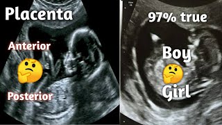 How to find gender in placenta  during pregnancy in kannada  97  is correct [upl. by Emmett]