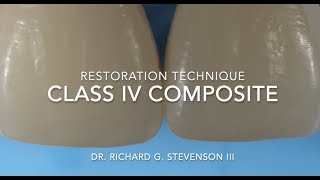 Class IV Composite Restoration  Restoration Technique [upl. by Assil]