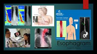 GabrielAvina 3MT Esophagram [upl. by Kramlich285]