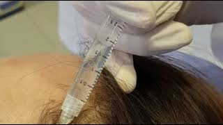 Painless Mesotherapy for Hair Fall [upl. by Maribel]