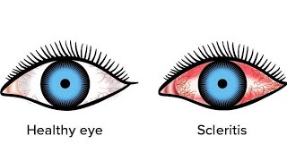 ScleritisEpiscleritis  in very easy way eyedisorders scleritis episcleritis shalakyatantra [upl. by Burman]