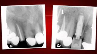 Implant Case 7  Dr Tarun Agarwal Part 10 Post OP xray [upl. by Shatzer]