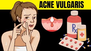 Acne Vulgaris  Causes Risk Factors Signs And Symptoms And Various Treatment Options [upl. by Egor]