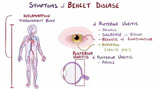 Behcet Disease  Osmosis [upl. by Bopp983]