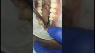 Left upper premolar molar replacement with basal implants and g cam bridge 40 micron clearance test [upl. by Seabury]