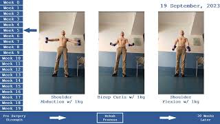 Calisthenics Intermediate Athlete  Biceps Tenodesis 5 Month Recovery [upl. by Curkell140]