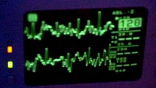 10  ergometer and ecg [upl. by Kawasaki]