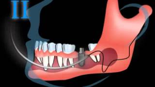 Live OP wie wird ein Zahnimplantat gesetzt  Implantation [upl. by Elconin816]