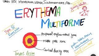 Erythema Multiforme EM causes symptoms treatment  skin disorder [upl. by Inanaup]