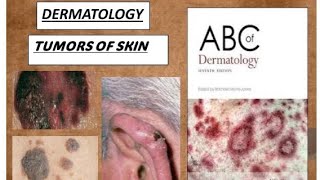 DERMATOLOGY TUMORS OF EPIDERMIS DERMIS amp MELANOCYTES PART2 benign amp malignant derma tumors [upl. by Montano]