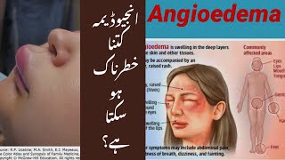 Angioedema Urdu video [upl. by Emmaline3]