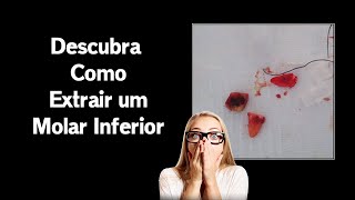 Exodontia 2º Molar Inferior – Dentista Comenta Caso Clínico Com Osteotomia e Odontosecção [upl. by Engapmahc]