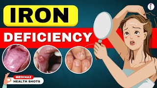 10 Weird Signs Youre Low on Iron  Iron Deficiency Anemia  Iron Deficiency Symptoms [upl. by Yreffej]