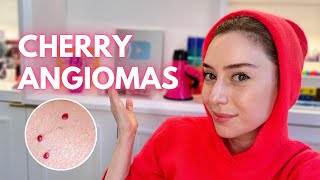 Cherry Angiomas How To Treat Them  Demo  Dr Shereene Idriss [upl. by Morrissey]