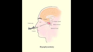 Craniotomy for craniosynostosis CPT code  simplify medical coding [upl. by Rucker]