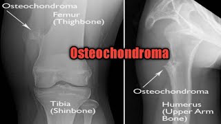 Osteochondroma  solitary and multiple pathology oncology cancer [upl. by Enelram]