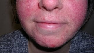 How to Treat Facial Eczema DermTVcom Epi 479 [upl. by Domella783]