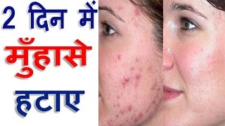 Remove Pimple Marks Forever Acne Home Remedies Acne Treatment in Hindi [upl. by Mitman]