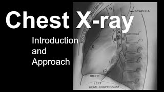 Chest Xray Introduction and Approach [upl. by Otrebogad]