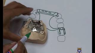 Designing an Upper Metal Partial Denture Kennedy Class IV [upl. by Gnirol53]