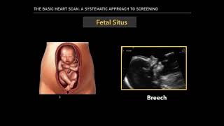 The Basic Fetal Heart Scan [upl. by Ahcila]