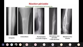 Visioconf  Imagerie  tumeurs osseuses et arthropathies [upl. by Ilaw]