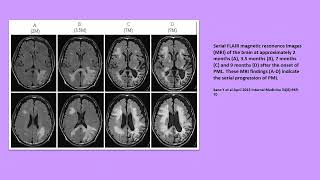 Neurology Quiz 95 Progressive multifocal leukoencephalopathy PML [upl. by Frissell]