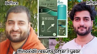 Minoxidil Tugain 5 result after 1 year of use  Case study [upl. by Bumgardner]