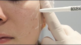 Skin Biomodulation with INNO CE® MOIST [upl. by Avahc343]