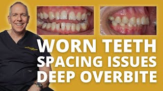 Dentistry Case Poor Aesthetics with Deep Overbite and Traumatic Occlusion [upl. by Iaht122]