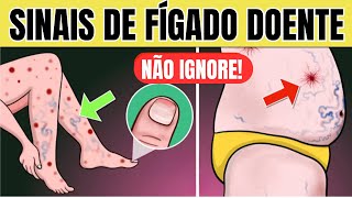 10 SINAIS de PROBLEMA no FÍGADO na PELE  Sintomas de GORDURA NO FÍGADO CIRROSE e HEPATITE [upl. by Alleirbag]